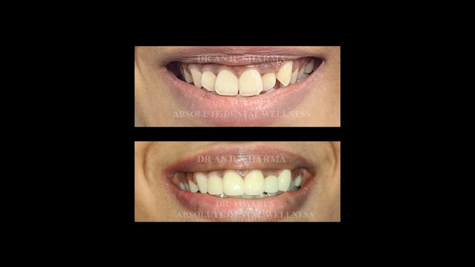 Smile Transformation 3